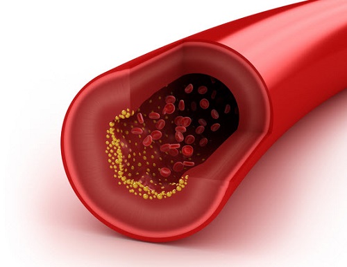 El colesterol en relación al cáncer de próstata